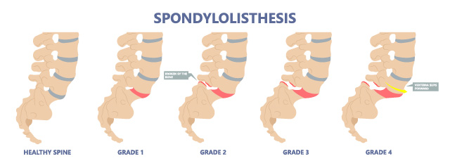 The 5 stages of spondylolisthesis, which causes sciatica.