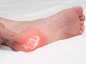 A person experiencing pain in the heel caused by plantar fasciitis.