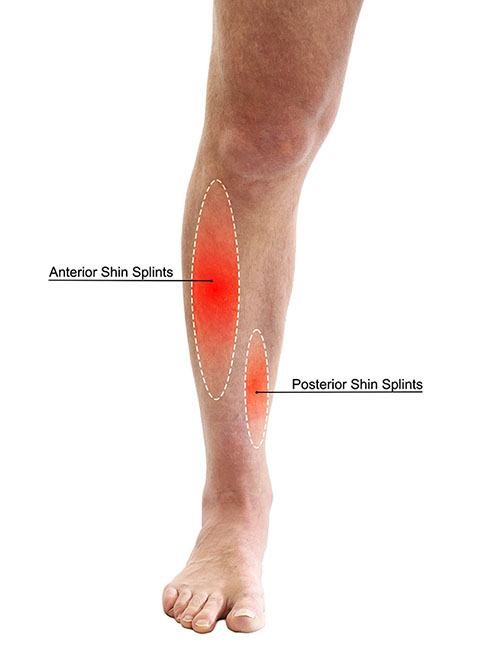 The symptoms of anterior shin splints and posterior shin splints.