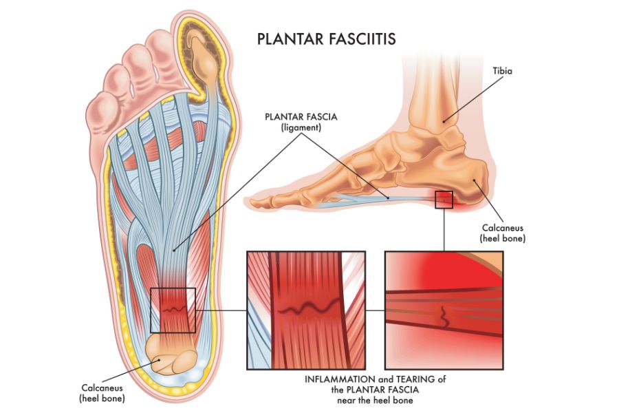 Relevant anatomy of the plantar fascia in the foot.